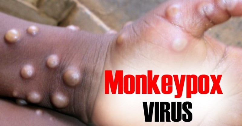 Monkeypox Virus: What You Need to Know About the Fast-Spreading Disease and Its Dangers