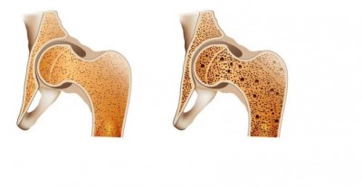 How to Strengthen Your Bones and Prevent Osteoporosis with Proper Nutrition