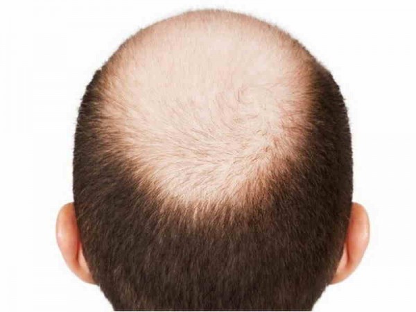 How to Spot the Warning Signs of Alopecia