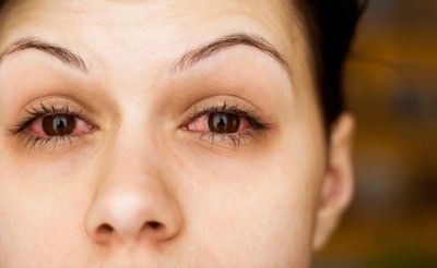 Protect Your Eyes: 5 Effective Ways to Prevent Conjunctivitis