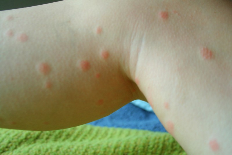 Symptoms and Warning Signs of Chigger Bites