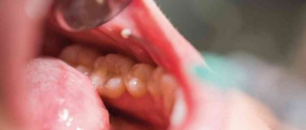 Chewing Tobacco increases the chances of Mouth cancer by 50 times, symptoms causes of mouth cancer
