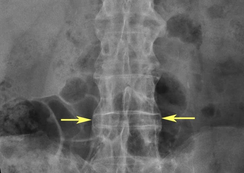 Understanding Spondylitis Care: A Doctor's Recommendations