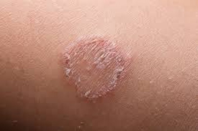 Shield Your Skin: How to Prevent Ringworm and Itching this Season
