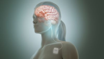 Vagus nerve stimulator provides improvement in health of depression patients