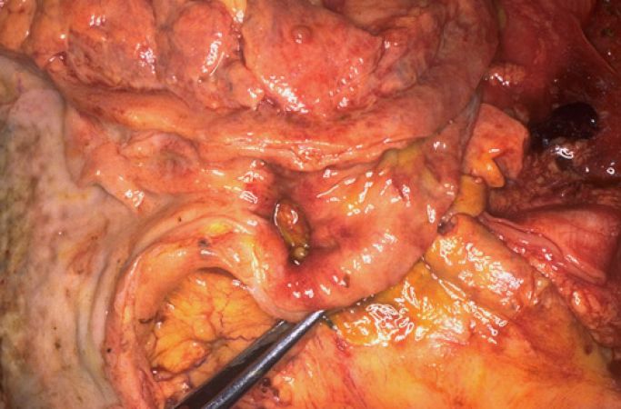 The truth behind Gastric and Duodenal Ulcers