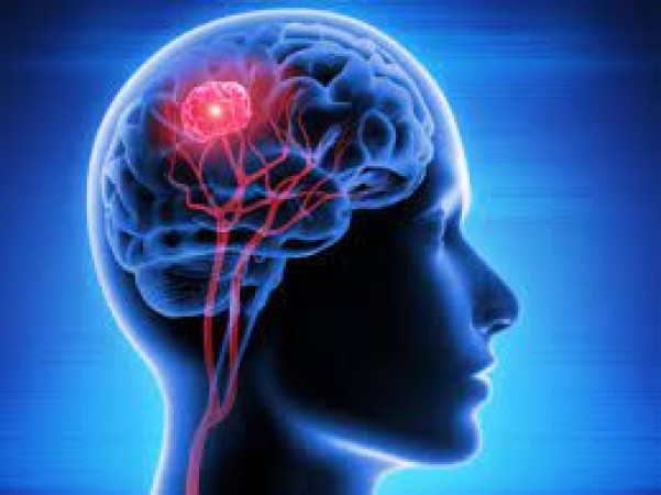 Decoding Brain Tumor Symptoms: When Headaches Signal Something More