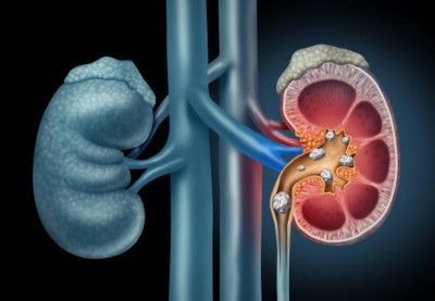 Stones Aren't Limited to Kidneys: Preventing Stone Formation in 6 Body Parts