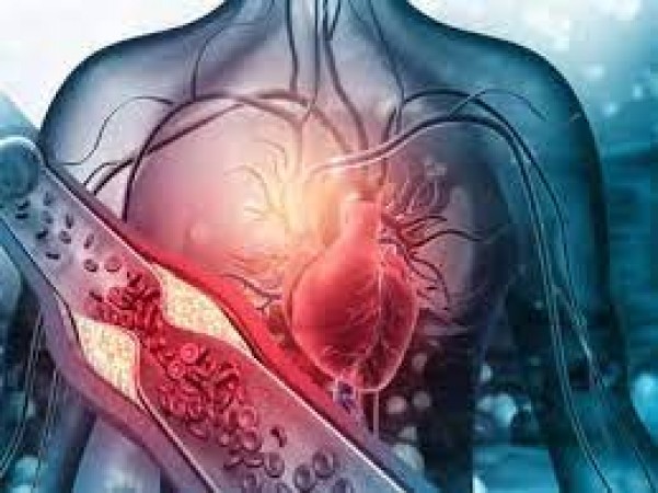 Heart Health Alert: Understanding Cholesterol's Impact on Heart Attacks