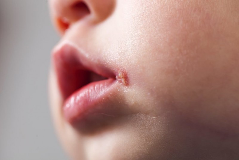 Warning Signs of Canker Sores: What to Watch Out For