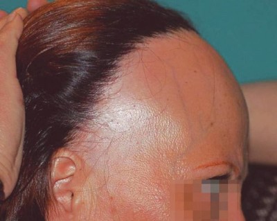 How to Spot the Warning Signs of Alopecia