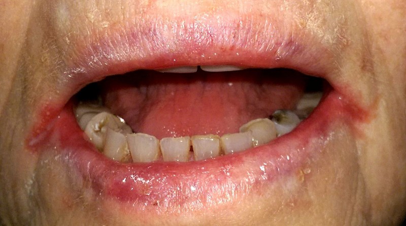 According to experts, common signs of angular cheilitis
