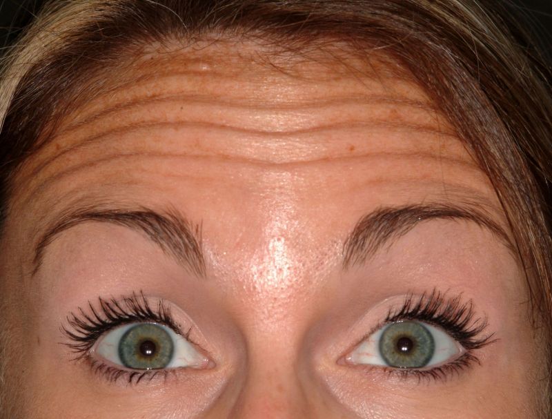 Forehead wrinkles, a major symptom of Artherosclerosis