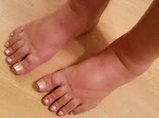 Swollen Feet? Don't Delay, Get Checked to Avoid Kidney Trouble