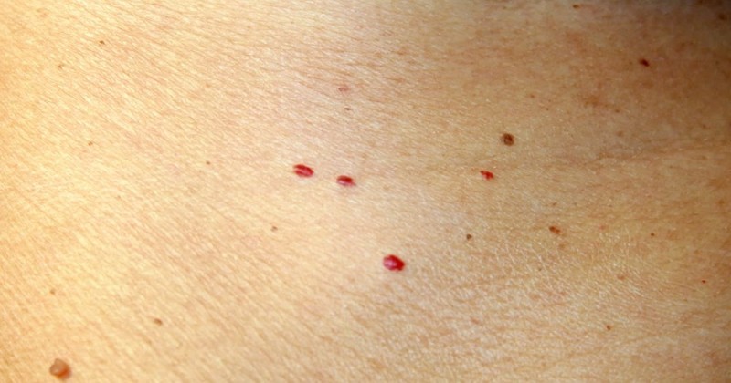 What your skin tags, moles, and freckles reveal about your health?