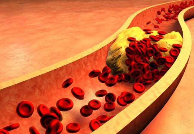 Take these tips to keep cholesterol in control.