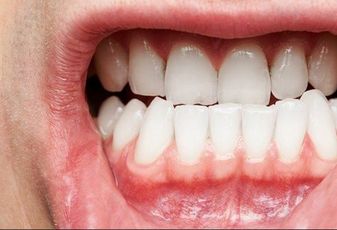 Don't Overlook Gum Infections: Seek Timely Treatment