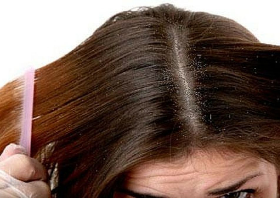 Make this anti-dandruff shampoo at home and get rid of hair problems