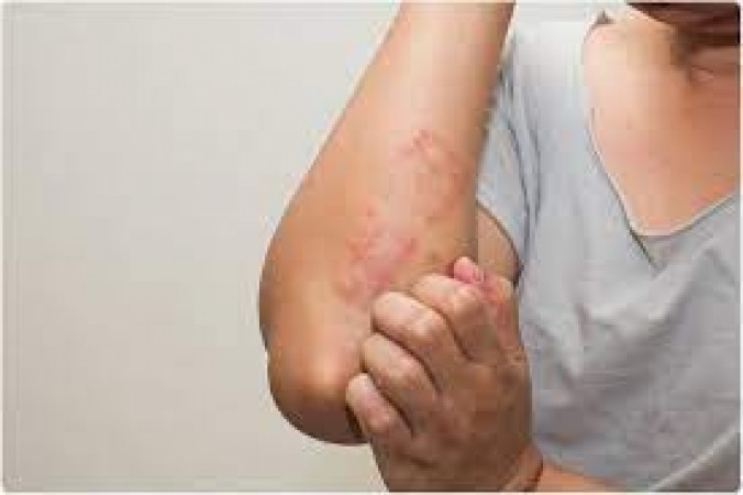 Do not consider such skin problems as side effects of cold, you can get infected by Omicron
