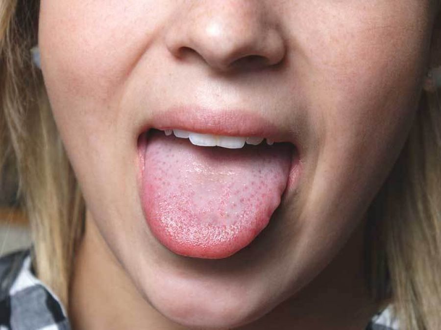 Try these home remedies to get rid of burning tongue