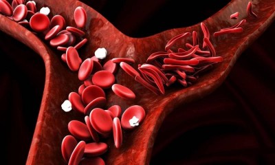 DCGI approves hydroxyurea for treatment of sickle cell anaemia