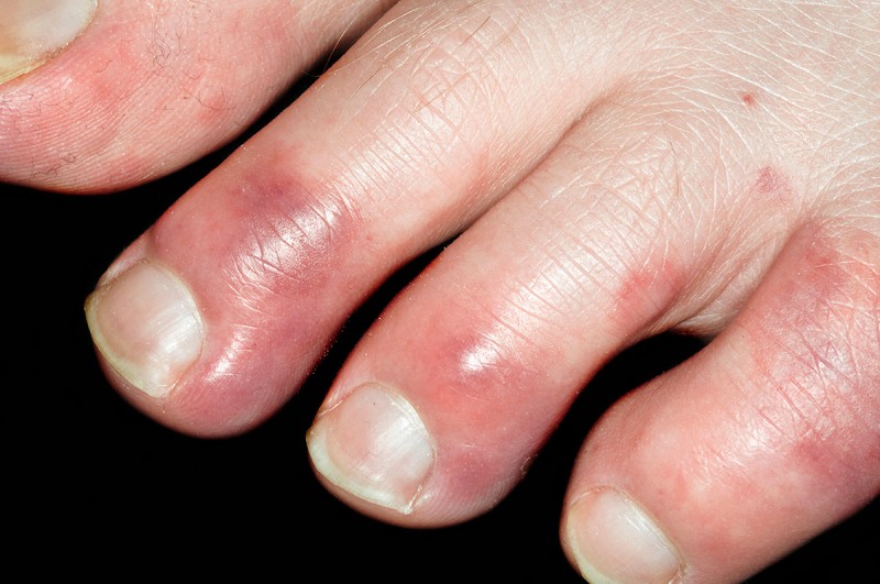 Chilblains: Does your skin itch in winter? These are the serious reasons behind this