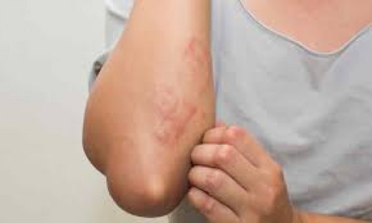 Do not ignore skin infection in rain, it can lead to serious illness