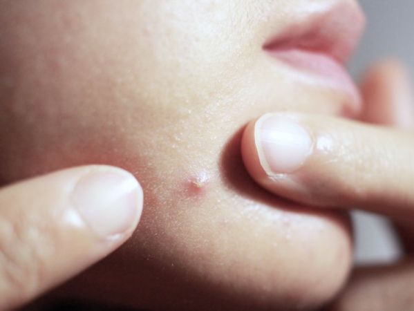 Simple and amazing tips to avoid pimples