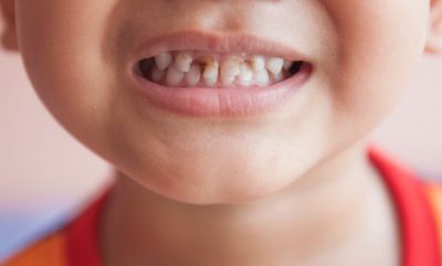 Overuse of toothpaste may leads to tooth decay in children