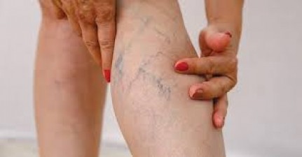 The appearance of blue veins on the legs is a symptom of a serious illness! Know how it can be done right?