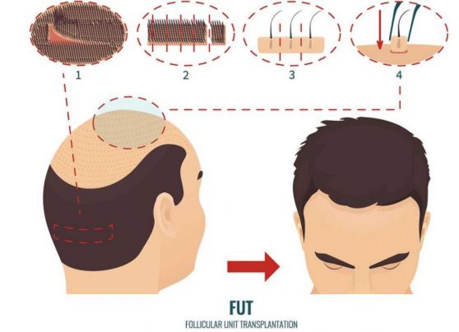 Cost of hair transplantation in India - Dr. Ankur Singhal