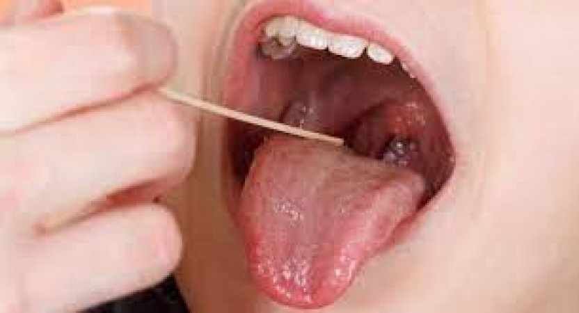 Are tongue ulcers troubling you? You can get relief from pain in a jiffy with these 5 home remedies
