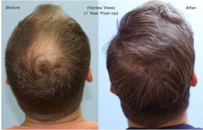 Cost of hair transplantation in India - Dr. Ankur Singhal