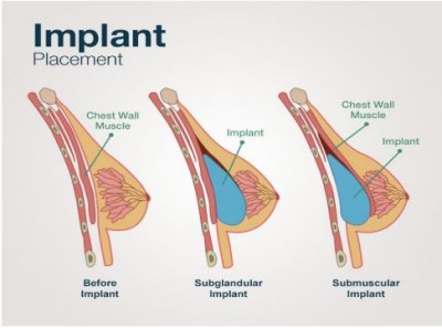 What is Breast Augmentation, and what is the procedure for it?