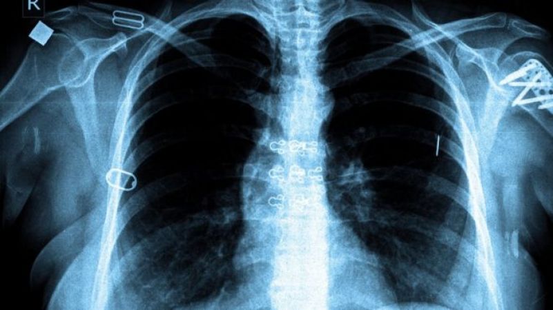 Novel tools could help treat patients with tuberculosis