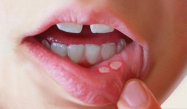 Try it Now! The Home Remedies For Mouth Ulcers