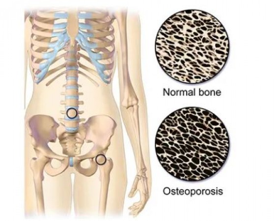 Bones are becoming weak before age, cases of osteoporosis are increasing rapidly