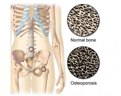 उम्र से पहले कमजोर हो रही हैं हड्डियां, तेजी से बढ़ रहे हैं ऑस्टियोपोरोसिस के मामले