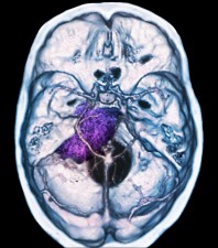 These are the reasons due to which brain tumor can occur, know