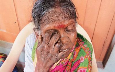 Unbelievable rates of  leprosy cases in India