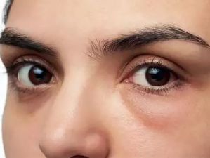 Amazing tips to get rid of puffy eyes