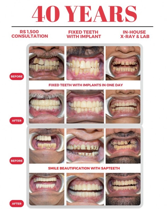 Full Mouth Rehabilitation in One Day: Advanced Dentistry in Mumbai