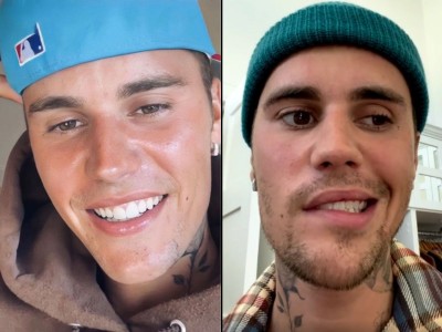 Justin Bieber's Rare Health Condition: Understanding Ramsay Hunt Syndrome
