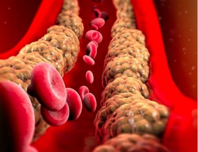 High Cholesterol: A Silent Killer That Can Lead to Heart Attack and Stroke