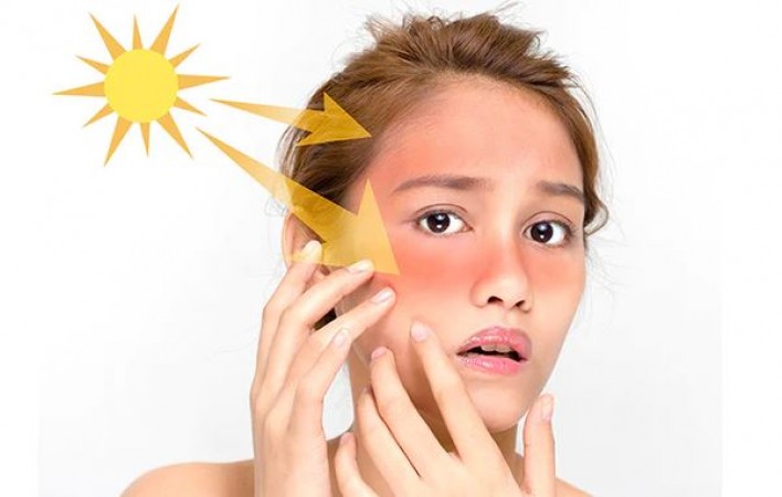 Relax and Heal: 8 Effective Sunburn Relief Tips