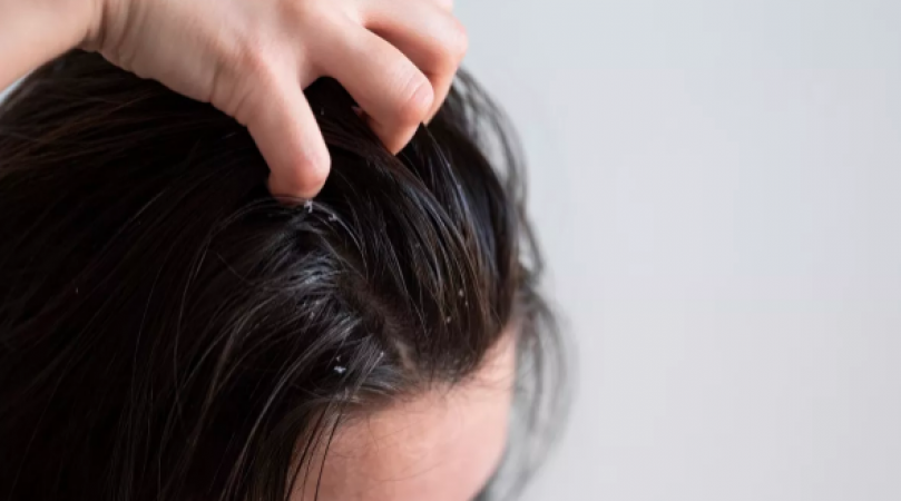 A fungus infection can also occur on the scalp during the monsoon, Use these steps to treat it