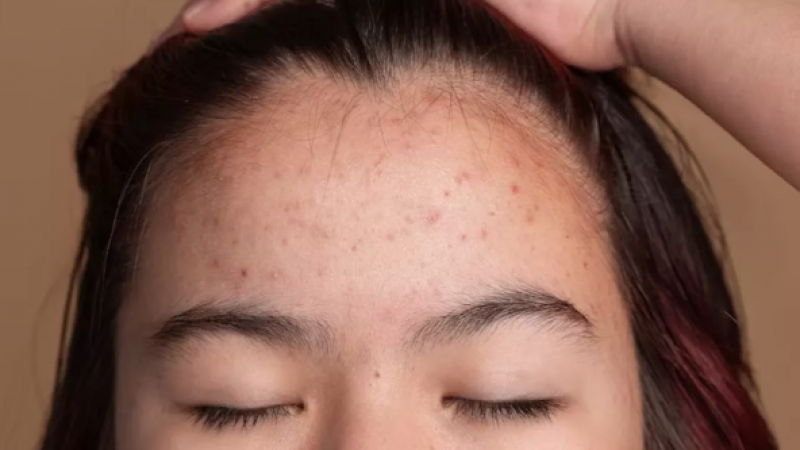 Remove stubborn blackheads from your forehead with these home and natural remedies