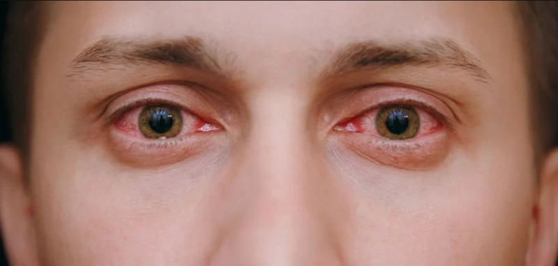 Causes of Conjunctivitis (Eye Flu) and How to Prevent It