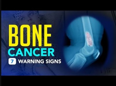 7 Common Symptoms of Bone Cancer