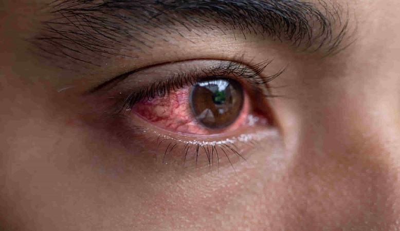 Eye Flu in Rainy Season: Symptoms, Cure, and Treatments